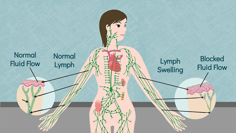 Lymphedema Stages
